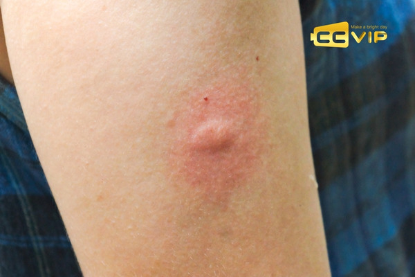 con muỗi số mấy